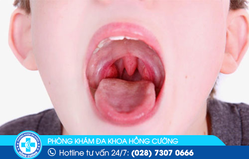 Mọi người cần quan sát vòm họng bình thường để nhận biết tình trạng sức khỏe