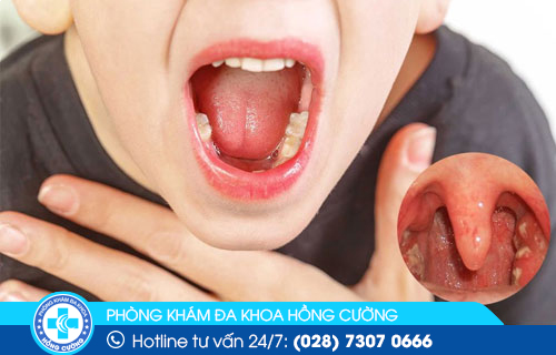Viêm họng là một bệnh lý vòm họng thường gặp 